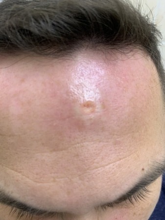 241110 L82 Себорейный кератоз после