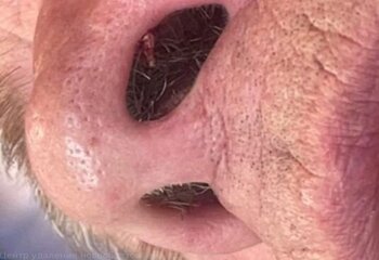 Удаление на носу