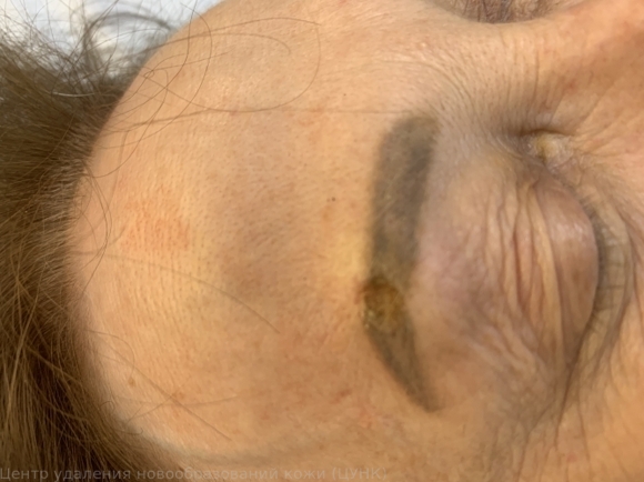B07 Вирусные бородавки1