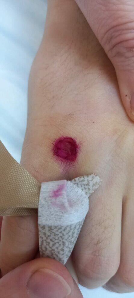 Удаление новообразований методом электрокоагуляции