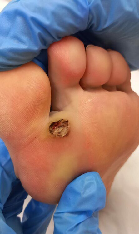 Удаление подошвенных бородавок