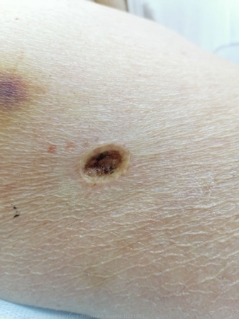 L82 Себорейный кератоз3