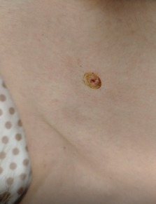 20250217-1 D22.5 Меланоформный невус туловища после