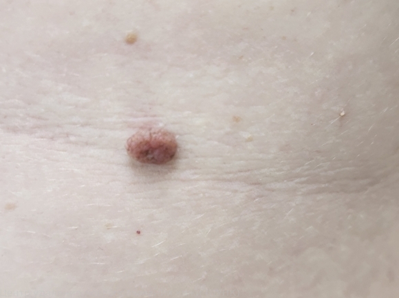D22.5 Меланоформный невус туловища до