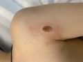 D22.6 Меланоформный невус верхней конечности, включая область плечевого пояса