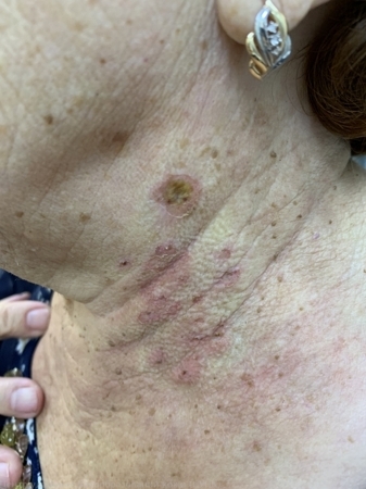 L82 Себорейный кератоз1