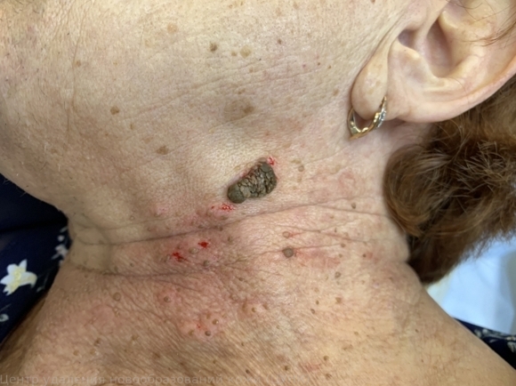 L82 Себорейный кератоз