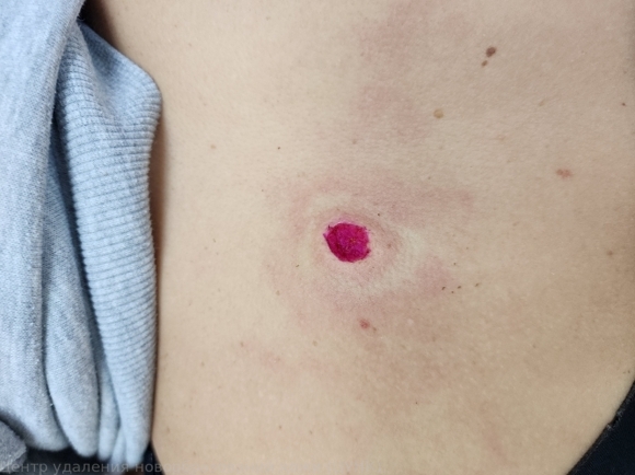 241205 D22.5 Меланоформный невус туловища после