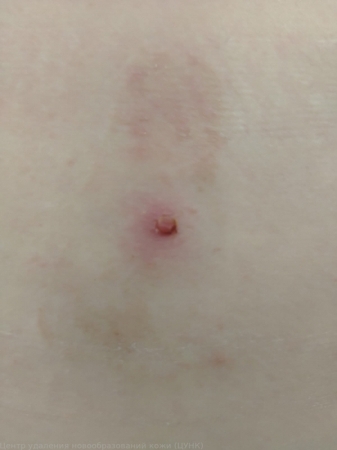 L98.0 Пиогенная гранулема 0 удаление новообразования на теле лазером в Кемерове
