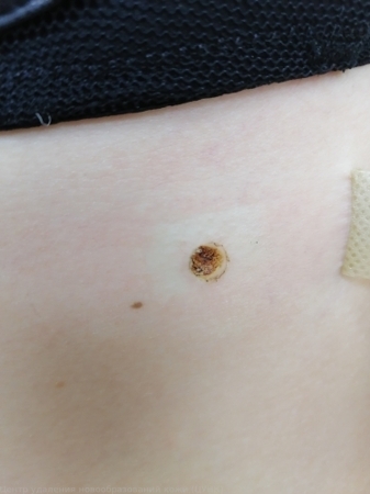 241119 D22.5 Меланоформный невус туловища до 2