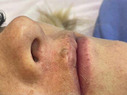 Радиоволновое удаление образований кожи