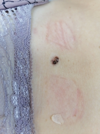 20250313 L82 Себорейный кератоз до