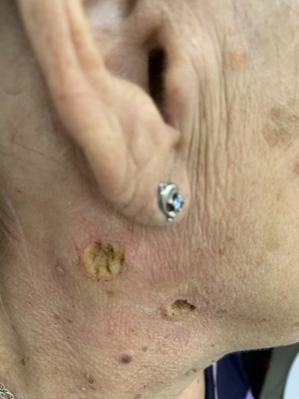 L82 Себорейный кератоз5