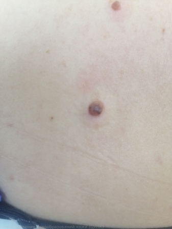 301124 D22.5 Меланоформный невус туловища до