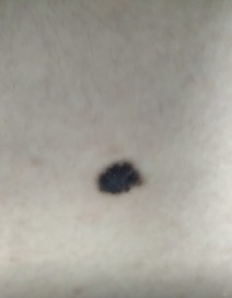20250217-2 D22.5 Меланоформный невус туловища до