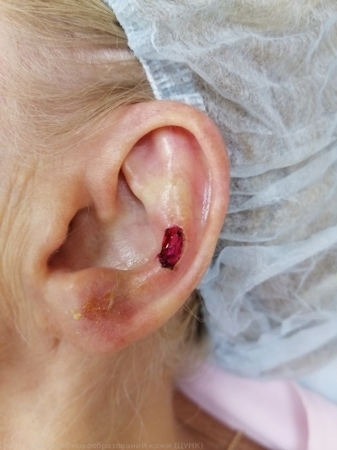 20241020 L82 Себорейный кератоз ухо 1